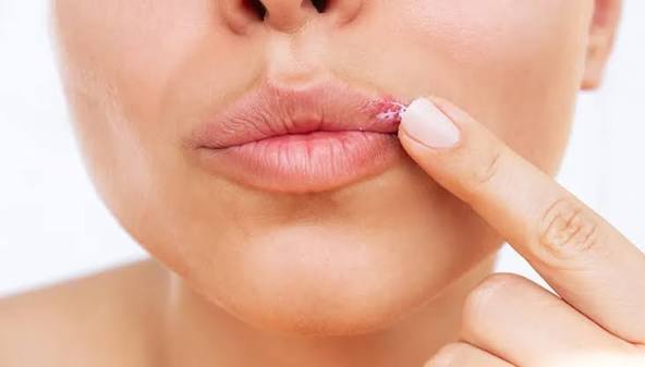 El truco para prevenir el herpes labial: usar bálsamo con protección solar